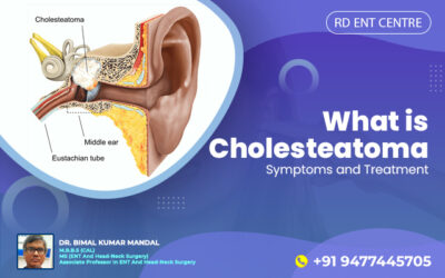 What is Cholesteatoma- Symptoms and Treatment